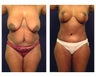 Mommy Makeover
