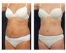 Abdominoplasty - Tummy Tuck