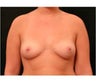 Mommy Makeover Nipple Correction