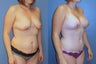 Breast augmentation/mastopexy and abdominoplasty