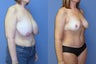 breast reduction and abdominoplasty