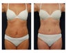 Abdominoplasty - Tummy Tuck