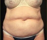 Tummy Tuck