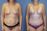 Breast augmentation/mastopexy and abdominoplasty