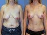 Breast augmentation/mastopexy and abdominoplasty