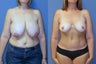 breast reduction and abdominoplasty