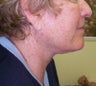 Neck lift
