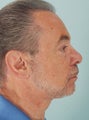 Neck Lift