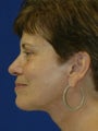 Lower Facelift and Necklift with Platysmaplasty