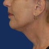 Lower Facelift and Necklift with Platysmaplasty