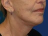 Lower Facelift and Necklift with Platysmaplasty