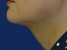 Submental liposuction (Liposuction under the chin)