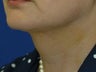 Submental liposuction (Liposuction under the chin)