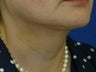 Submental liposuction (Liposuction under the chin)