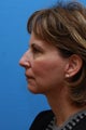 Necklift and Chin Enhancement
