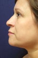 Liposuction- Neck