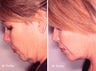 Neck Lift