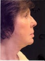 53 year old female before and after neck and face lift