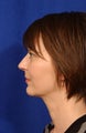 Neck-lace procedure with anatomic chin implant