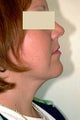 Neck Liposuction