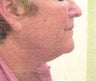 Neck lift