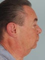 Neck Lift