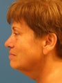 Lower Facelift and Necklift with Platysmaplasty
