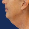 Lower Facelift and Necklift with Platysmaplasty