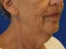 Lower Facelift and Necklift with Platysmaplasty