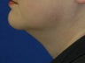 Submental liposuction (Liposuction under the chin)