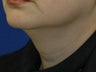 Submental liposuction (Liposuction under the chin)
