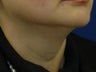 Submental liposuction (Liposuction under the chin)