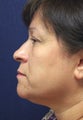 Liposuction- Neck