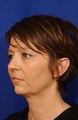 Neck-lace with anatomic chin implant
