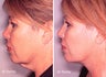 Neck Lift