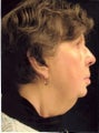 53 year old female before and after neck and face lift