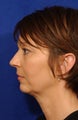 Neck-lace procedure with anatomic chin implant