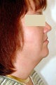Neck Liposuction