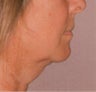 Neck Lift