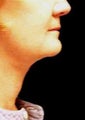 Neck Lift