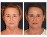 Face & Neck Lift with Fat Grafting