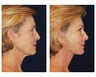 Neck Lift
