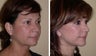 Necklift