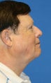 Neck Lift