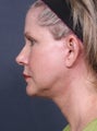 Neck Lift