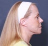 Neck Lift