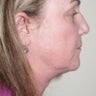 Neck Lift