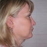 Neck Lift
