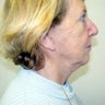 Neck Lift