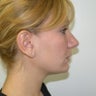 Submental Lipectomy and Neck Plasty